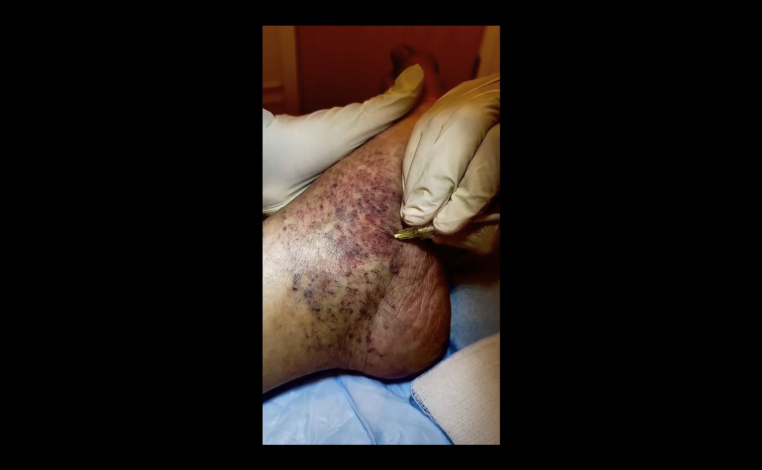 Sclerotherapy Treatment Video 4