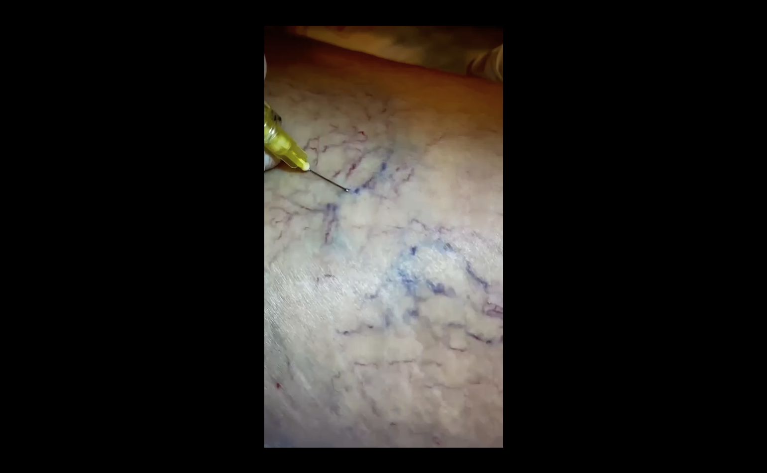Sclerotherapy Treatment Video 5
