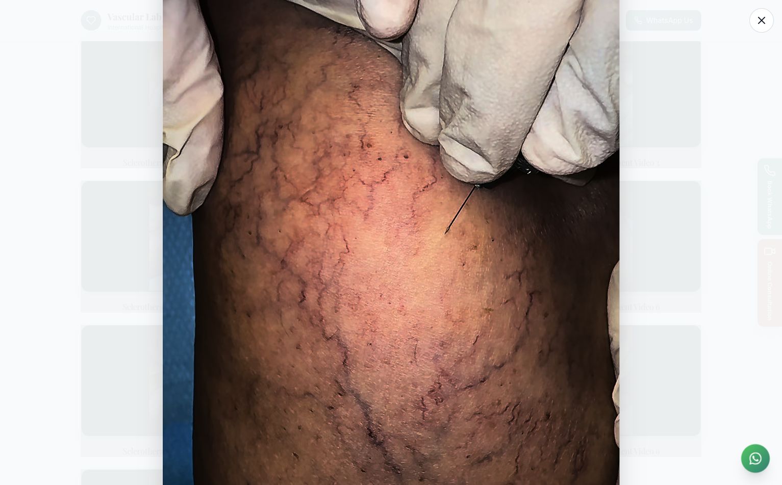 Sclerotherapy Treatment Video 6